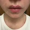 ヒアルロン酸注入（唇） AZ BEAUTY CLINIC AFTER サムネイル用