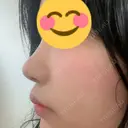 ヒアルロン酸注入（鼻） / ボトックス（人中） A CLINIC（エークリニック） 福岡院 DAY 4 サムネイル用