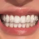 矯正（マウスピース） 銀座青山You矯正歯科 池袋西口医院 AFTER サムネイル用