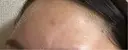 リジュラン CZEN CLINIC 銀座院 DAY 4 サムネイル用