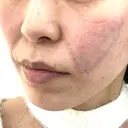 糸リフト / ボトックス（エラ・小顔） / ボトックス（額） / ボトックス（バニーライン） / ピコレーザートーニング（美白・肝斑） / ショッピングリフト APスキンクリニック銀座 DAY 0 サムネイル用