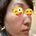 イオン導入 / ピーリング（ハリ・ツヤ） / ルメッカ ルラ美容クリニック 千葉院 / ルラスキンクリニック 千葉院 AFTER サムネイル用