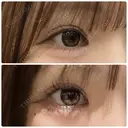 目尻切開 / タレ目形成・グラマラスライン（埋没） LOUIS CLINIC 二子玉川院【ルイクリニック】 DAY 9 サムネイル用