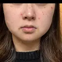 ほくろ・いぼ除去レーザー（肌） Fellez Clinic【フェルズクリニック】 AFTER サムネイル用
