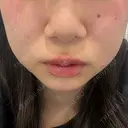 オンダリフト ルラ美容クリニック 渋谷本院 DAY 0 サムネイル用