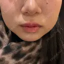 オンダリフト ルラ美容クリニック 渋谷本院 AFTER サムネイル用