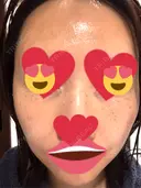 ピコスポット Fellez Clinic【フェルズクリニック】 DAY 4 サムネイル用