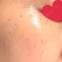 ピコスポット Fellez Clinic【フェルズクリニック】 DAY 4 サムネイル用