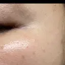 ほくろ・いぼ除去レーザー（肌） Fellez Clinic【フェルズクリニック】 AFTER サムネイル用