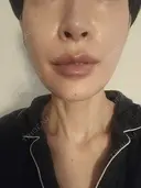 糸リフト 形成外科と美容外科のクリニック池袋 AFTER サムネイル用