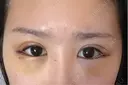 目尻切開 / タレ目形成・グラマラスライン（切開） BIANCA銀座 DAY 2 サムネイル用