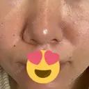 ニードルRF（ポテンツァなど） レナータクリニック 立川院 DAY 1 サムネイル用