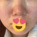 ニードルRF（ポテンツァなど） レナータクリニック 立川院 DAY 0 サムネイル用