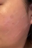 その他（肌） / シミ取りレーザー / ルメッカ ルラ美容クリニック 郡山院 AFTER サムネイル用