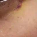 リジュラン 千葉美容外科アイビークリニック DAY 5 サムネイル用