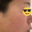 ルビーレーザー AZ BEAUTY CLINIC DAY 5 サムネイル用