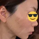 ルビーレーザー AZ BEAUTY CLINIC AFTER サムネイル用