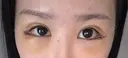 目尻切開 / タレ目形成・グラマラスライン（切開） BIANCA銀座 DAY 3 サムネイル用