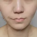 糸リフト 形成外科と美容外科のクリニック池袋 DAY 5 サムネイル用