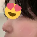 ヒアルロン酸注入（鼻） / ボトックス（人中） A CLINIC（エークリニック） 福岡院 DAY 6 サムネイル用