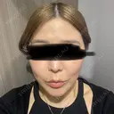 鼻尖形成（切開） / 小鼻縮小（切開） / 軟骨移植 ASTRA BEAUTY CLINIC AFTER サムネイル用