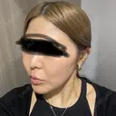 鼻尖形成（切開） / 小鼻縮小（切開） / 軟骨移植 ASTRA BEAUTY CLINIC DAY 287 サムネイル用