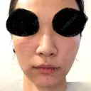 肌育注射（ジュベルックなど） CHARIS BEAUTY CLINIC AFTER サムネイル用