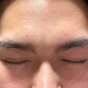 眼瞼下垂（切開） / 上まぶたの脂肪取り 新前橋かしま眼科形成外科クリニック DAY 168 サムネイル用