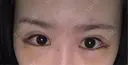 目尻切開 / タレ目形成・グラマラスライン（切開） BIANCA銀座 DAY 4 サムネイル用