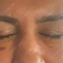 クマ治療 湘南美容クリニック 千葉センシティ院 DAY 5 サムネイル用