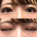 眼瞼下垂（切開） / 上まぶたの脂肪取り 白山クリニック 大分 DAY 47 サムネイル用