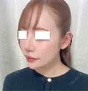 鼻尖形成（切開） / 軟骨移植 / 鼻修正 / 鼻孔縁挙上 / その他（鼻） WOM CLINIC GINZA （ワム クリニック ギンザ） DAY 8 サムネイル用