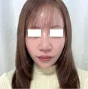 鼻尖形成（切開） / 軟骨移植 / 鼻修正 / 鼻孔縁挙上 / その他（鼻） WOM CLINIC GINZA （ワム クリニック ギンザ） DAY 7 サムネイル用