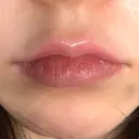 ヒアルロン酸注入（唇） HAAB×DREAM BEAUTY CLINIC 大阪梅田院 DAY 0 サムネイル用