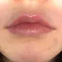 ヒアルロン酸注入（唇） HAAB×DREAM BEAUTY CLINIC 大阪梅田院 DAY 0 サムネイル用