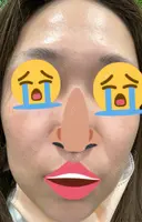 ピコレーザートーニング（美白・肝斑） / レーザートーニング（美白・肝斑） KARIS beauty clinic DAY 0 サムネイル用