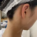 ピアス穴あけ 渋谷美容外科クリニック 新宿院 AFTER サムネイル用