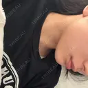 ボトックス（エラ・小顔） 小暮整形外科・美容外科 DAY 1 サムネイル用