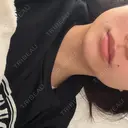 ボトックス（エラ・小顔） 小暮整形外科・美容外科 DAY 1 サムネイル用