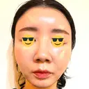 糸リフト / 脂肪吸引（顔） EMMA CLINIC（エマクリニック） DAY 14 サムネイル用