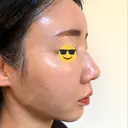 糸リフト / 脂肪吸引（顔） EMMA CLINIC（エマクリニック） DAY 14 サムネイル用