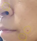 ほくろ・いぼ切除（肌） CLINIC W DAY 10 サムネイル用