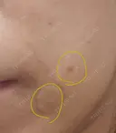 ほくろ・いぼ切除（肌） CLINIC W DAY 10 サムネイル用