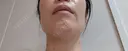 糸リフト / バッカルファット除去 / 脂肪吸引（顔） / ジョールファット除去 / ボトックス（エラ・小顔） アリエル美容クリニック 大宮院 DAY 92 サムネイル用