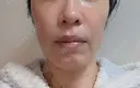 糸リフト / バッカルファット除去 / 脂肪吸引（顔） / ジョールファット除去 / ボトックス（エラ・小顔） アリエル美容クリニック 大宮院 DAY 92 サムネイル用