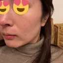 ボトックス（エラ・小顔） / ボトックス（口角） DMTC美容皮膚科 大宮院 DAY 2 サムネイル用