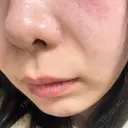 マイクロボトックス Natural Skin Clinic 自由ヶ丘院 DAY 0 サムネイル用