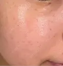 ルメッカ ルラ美容クリニック 高田馬場院 AFTER サムネイル用