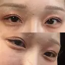 ヒアルロン酸注入（涙袋） 小倉美容外科/美容皮膚科 ビラビューティークリニック DAY 0 サムネイル用