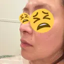 その他（鼻） / ボトックス（あご） / ボトックス（口角） / ボトックス（眉間） / ボトックス（額） 白金ビークリニック 本院 AFTER サムネイル用